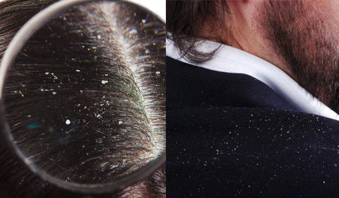 Who has more dandruff? Men or women?